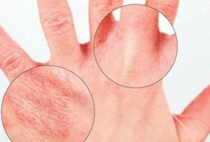 Основні причини сухості та тріщин шкіри на руках