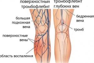 Kako možete vidjeti vene na nogama Zašto biste trebali raditi, kao što vidite na nogama?'явилися